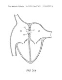 DEVICES, SYSTEMS, AND METHODS TO TREAT HEART FAILURE HAVING AN IMPROVED FLOW-CONTROL MECHANISM diagram and image