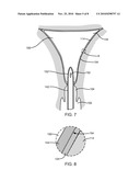 ADJUVANT ENHANCED ABLATION diagram and image