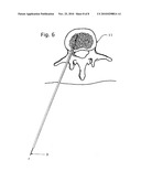 Steerable Surgical Guide Wire Introducer diagram and image