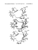 METHOD AND APPARATUS FOR CONTROLLING LESION SIZE IN CATHETER-BASED ABLATION TREATMENT diagram and image