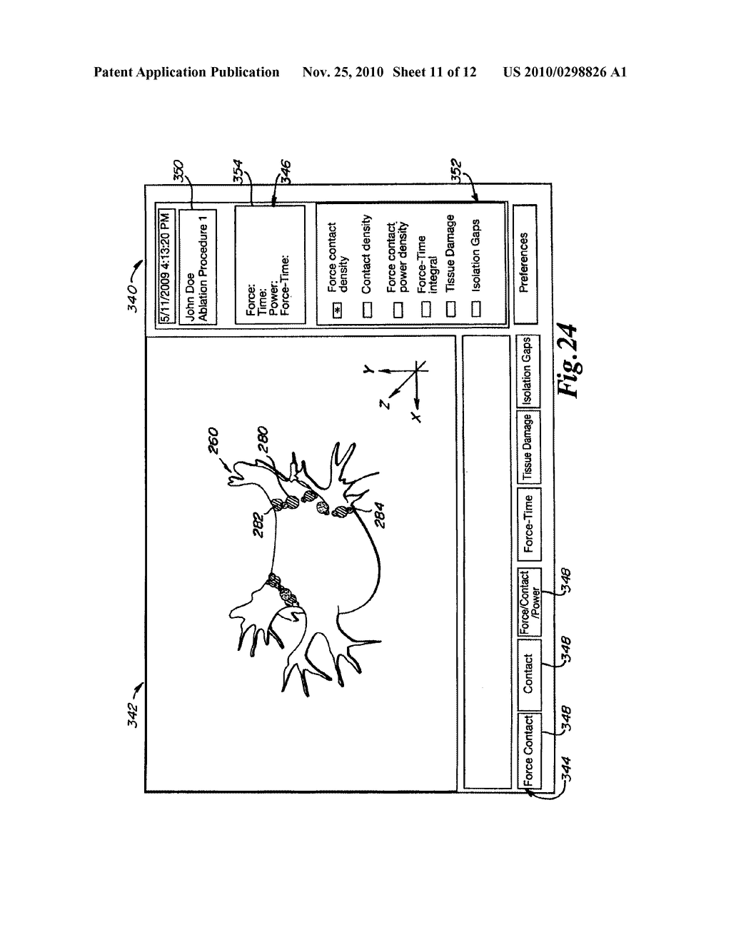 METHOD AND APPARATUS FOR CONTROLLING LESION SIZE IN CATHETER-BASED ABLATION TREATMENT - diagram, schematic, and image 12