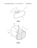  FIXATION DEVICE FOR THE FIXATION OF BONE FRAGMENTS diagram and image