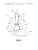  FIXATION DEVICE FOR THE FIXATION OF BONE FRAGMENTS diagram and image