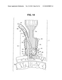 Autologous Bone Harvest During Osteotomy and Bone Drilling Procedures diagram and image