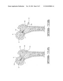 Pressured syringe for the injection of a viscous liquid through a cannulated surgical screw bone filler adapter diagram and image