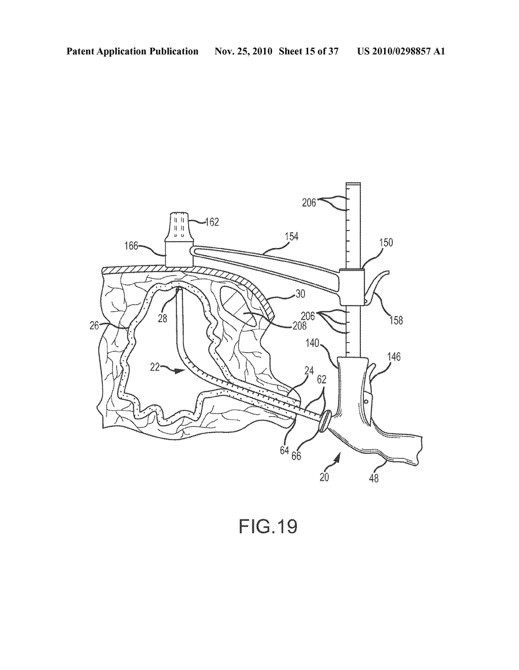 Apparatus and Method for Performing Cystotomy Procedures - diagram, schematic, and image 16