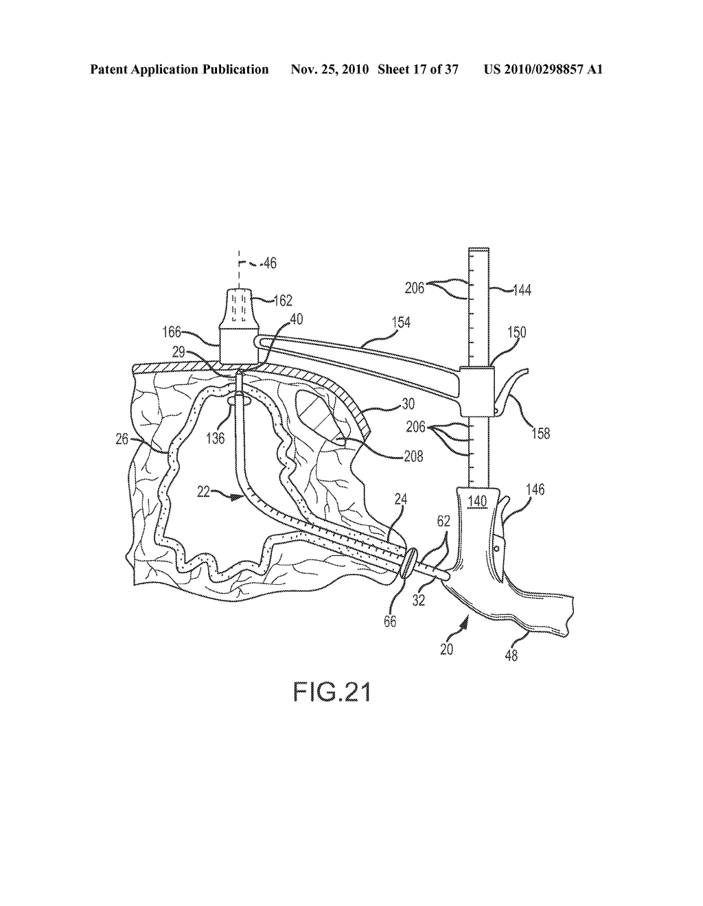 Apparatus and Method for Performing Cystotomy Procedures - diagram, schematic, and image 18