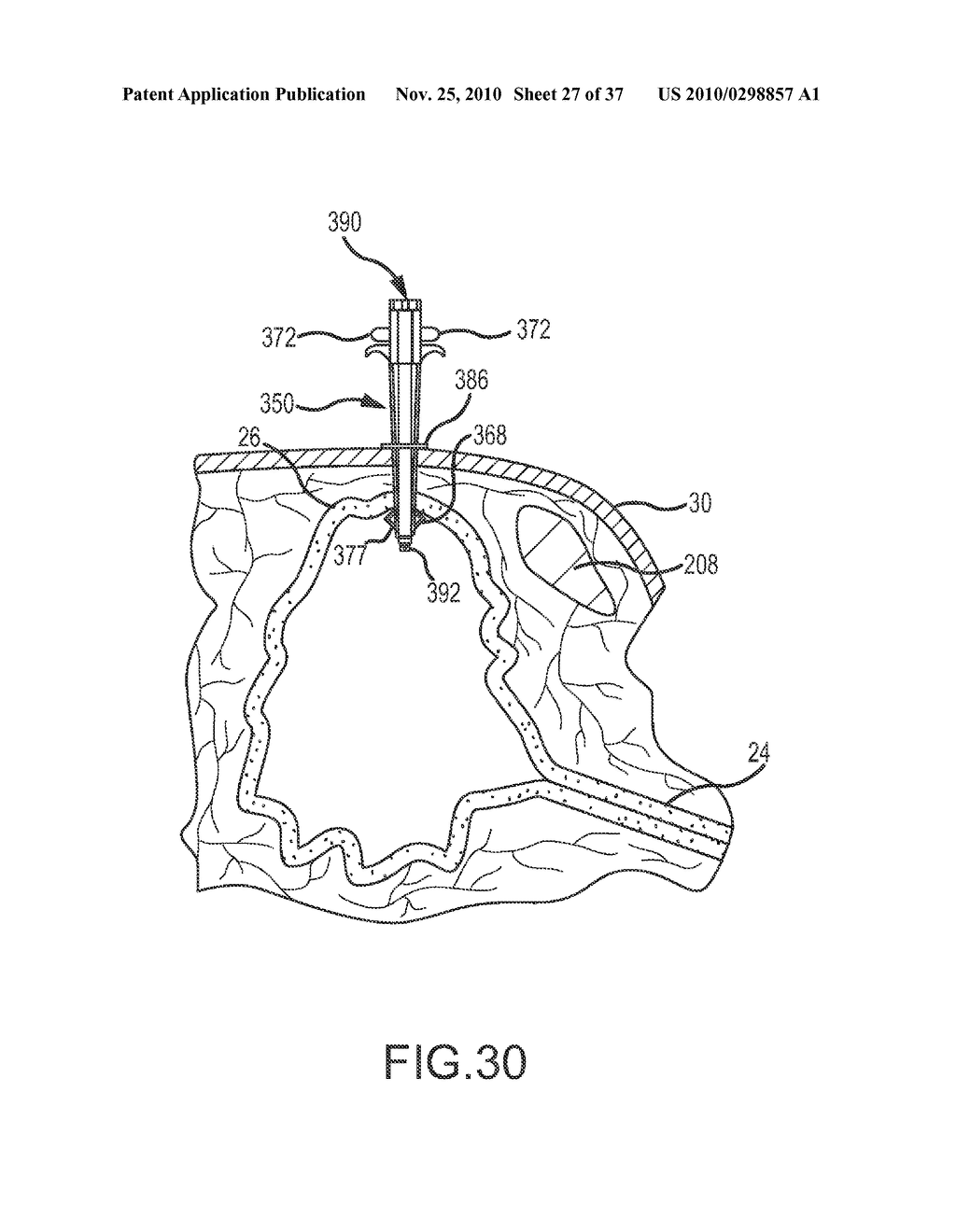 Apparatus and Method for Performing Cystotomy Procedures - diagram, schematic, and image 28