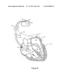 Selection of Cardiac Capture Verification Modes diagram and image