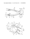 BAROREFLEX ACTIVATION FOR ARRHYTHMIA TREATMENT diagram and image