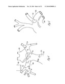 BAROREFLEX ACTIVATION FOR ARRHYTHMIA TREATMENT diagram and image