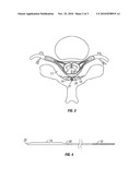 WINGED ELECTRODE BODY FOR SPINAL CORD STIMULATION diagram and image