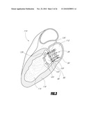 VASCULAR IMPLANT AND DELIVERY SYSTEM diagram and image