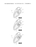 VASCULAR IMPLANT AND DELIVERY SYSTEM diagram and image