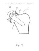 JOINT PROSTHESIS diagram and image