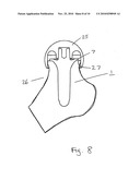 JOINT PROSTHESIS diagram and image