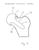 JOINT PROSTHESIS diagram and image