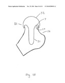 JOINT PROSTHESIS diagram and image