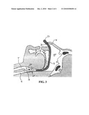 NASAL AIRWAY MANAGEMENT DEVICE WITH INFLATABLE SUPRAGLOTTIC LARYNGEAL CUFF diagram and image