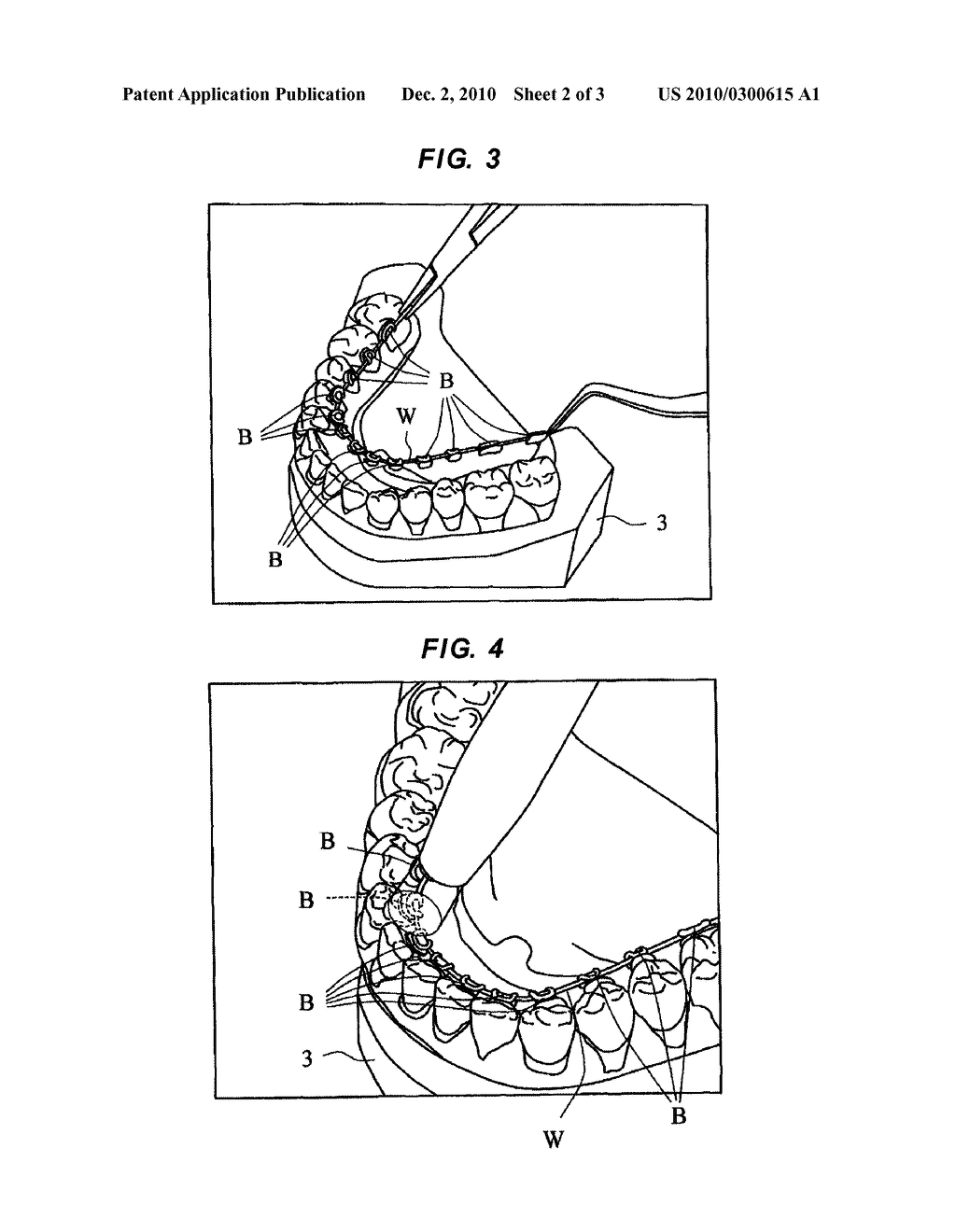 PRODUCTION METHOD OF ORTHODONTIC BRACKET WITH POSITIONING GUIDE - diagram, schematic, and image 03