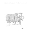 DENTAL SUPERSTRUCTURE, AND A METHOD OF MANUFACTURE THEREOF diagram and image