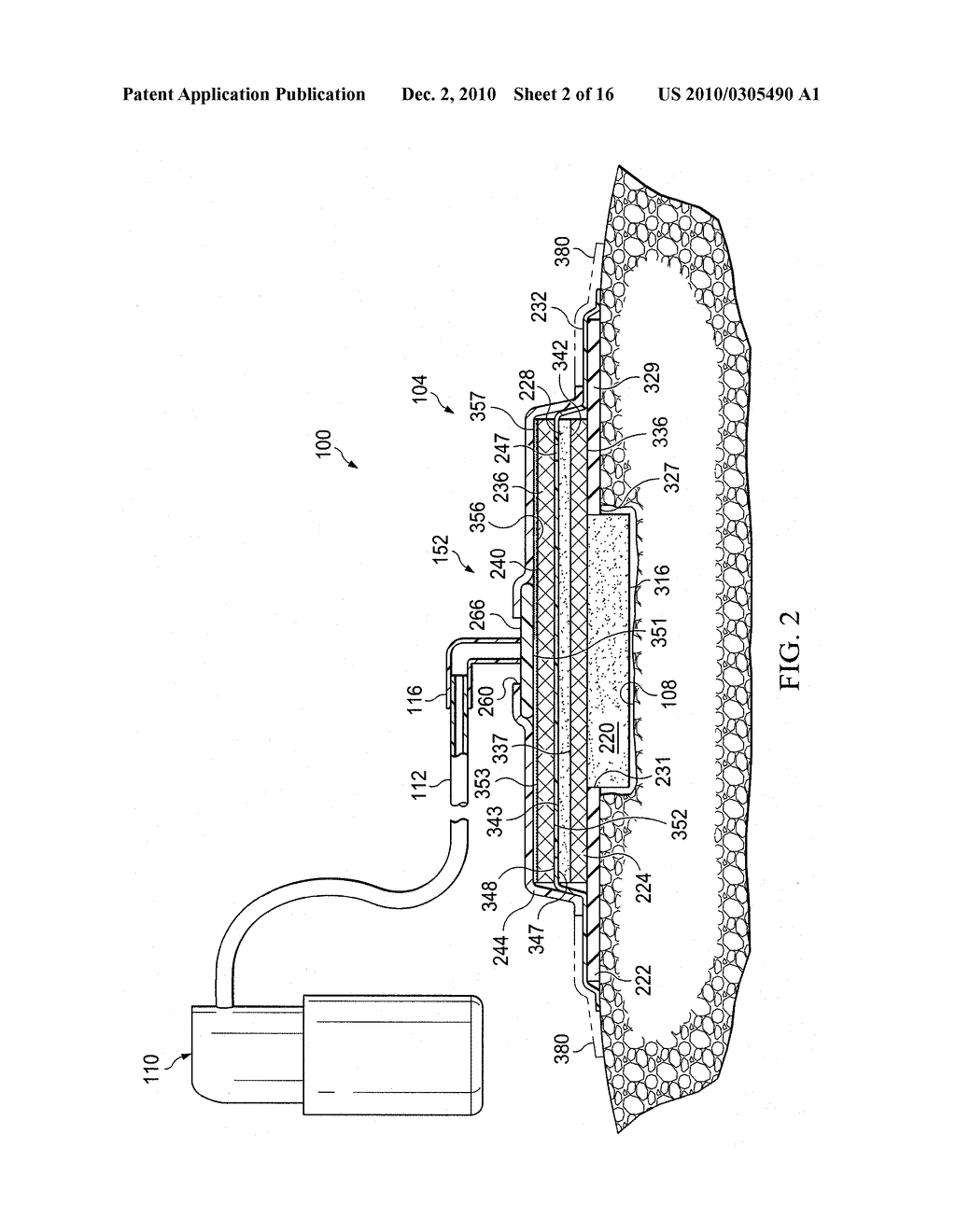 DRESSING AND METHOD FOR APPLYING REDUCED PRESSURE TO AND COLLECTING AND STORING FLUID FROM A TISSUE SITE - diagram, schematic, and image 03