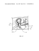 OPTICALLY GUIDED FEEDING TUBE, CATHETERS AND ASSOCIATED METHODS diagram and image