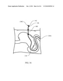 OPTICALLY GUIDED FEEDING TUBE, CATHETERS AND ASSOCIATED METHODS diagram and image