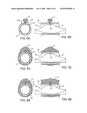 METHODS AND KITS FOR VOLUMETRIC DISTRIBUTION OF PHARMACEUTICAL AGENTS VIA THE VASCULAR ADVENTITIA AND MICROCIRCULATION diagram and image