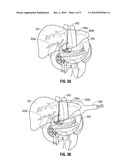 Microwave Ablation Safety Pad, Microwave Safety Pad System and Method of Use diagram and image