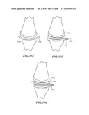 Patient Selectable Joint Arthroplasty Devices and Surgical Tools diagram and image