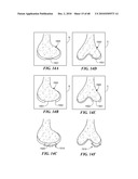 Patient Selectable Joint Arthroplasty Devices and Surgical Tools diagram and image