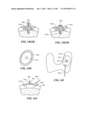 Patient Selectable Joint Arthroplasty Devices and Surgical Tools diagram and image