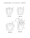 Patient Selectable Joint Arthroplasty Devices and Surgical Tools diagram and image