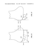 Patient Selectable Joint Arthroplasty Devices and Surgical Tools diagram and image