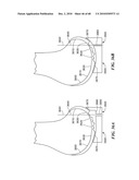 Patient Selectable Joint Arthroplasty Devices and Surgical Tools diagram and image