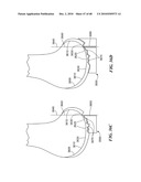 Patient Selectable Joint Arthroplasty Devices and Surgical Tools diagram and image