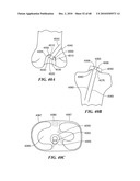 Patient Selectable Joint Arthroplasty Devices and Surgical Tools diagram and image