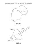 Patient Selectable Joint Arthroplasty Devices and Surgical Tools diagram and image