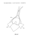 Patient Selectable Joint Arthroplasty Devices and Surgical Tools diagram and image