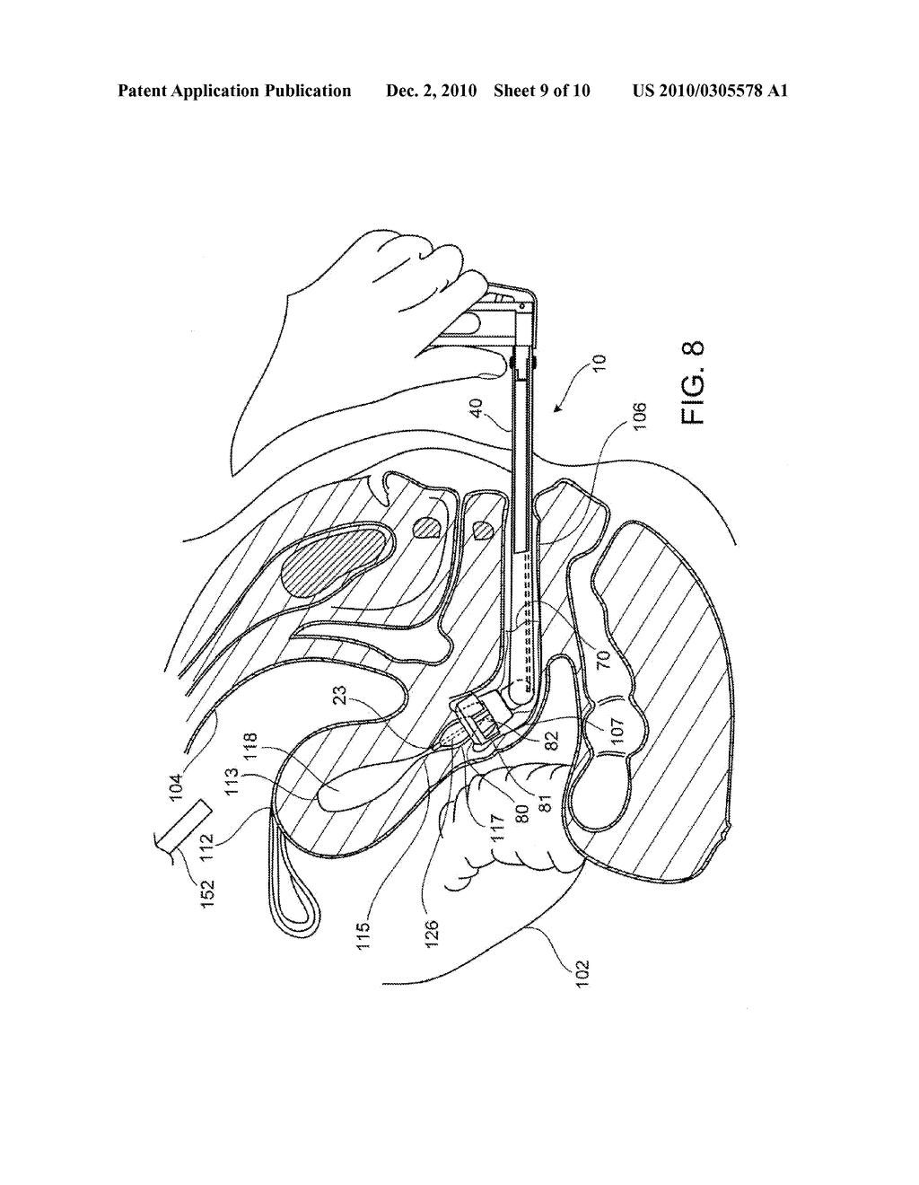 Uterine Manipulators and Related Components and Methods - diagram, schematic, and image 10