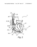 METHOD, DEVICE, IMPLANTABLE STIMULATOR AND DUAL CHAMBER CARDIAC THERAPY SYSTEM diagram and image