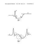 TACHYARRHYTHMIA DETECTION AND DISCRIMINATION BASED ON CURVATURE PARAMETERS diagram and image