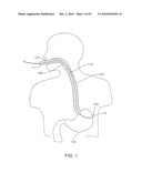 Gastric Simulation Anchor and Method diagram and image