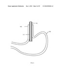 Gastric Simulation Anchor and Method diagram and image