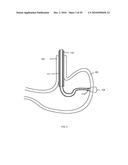 Gastric Simulation Anchor and Method diagram and image