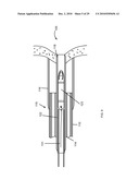 Gastric Simulation Anchor and Method diagram and image