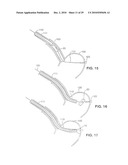 Gastric Simulation Anchor and Method diagram and image