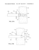 Gastric Simulation Anchor and Method diagram and image