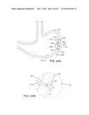 Gastric Simulation Anchor and Method diagram and image